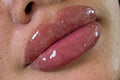 Lip Filler
