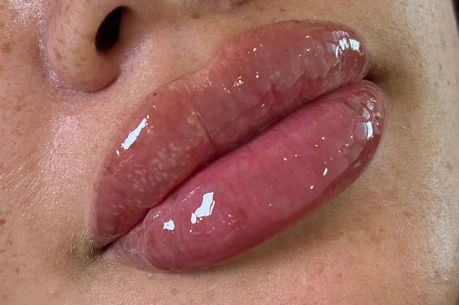 Lip Filler